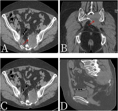 Application value of PET/CT in monophasic primary sacral synovial sarcoma: a case report and review of literature